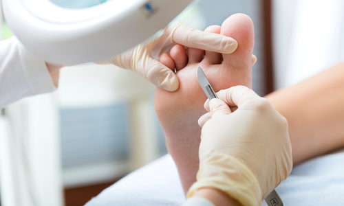 Osoba w rękawiczkach wykonuje zabieg podologiczny na stopie pacjenta.